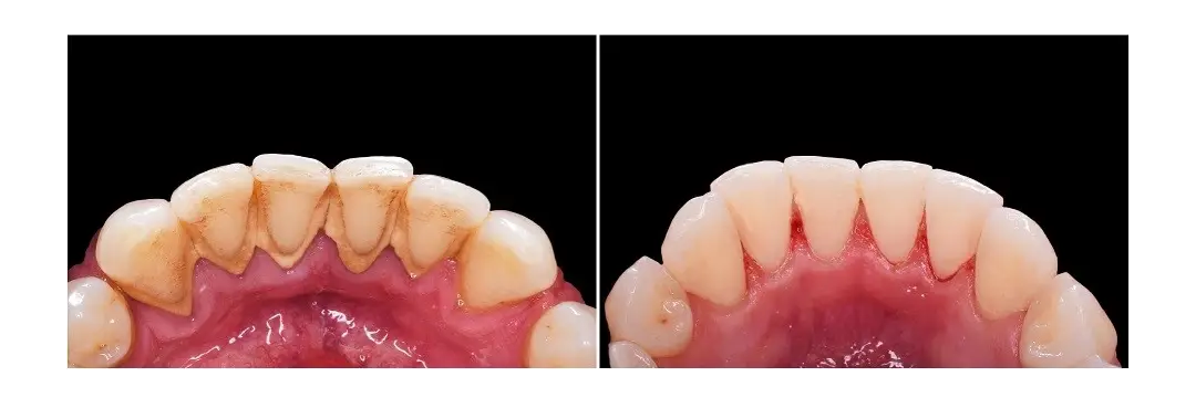 Teeth cleaning before and after best results